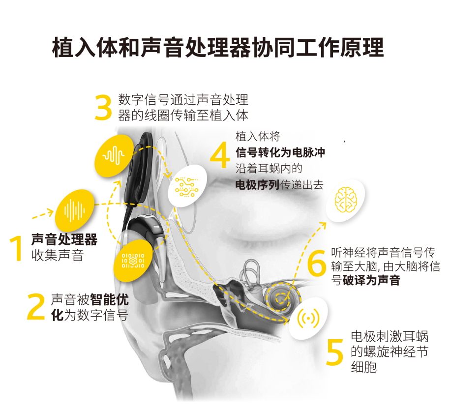 什么是人工耳蜗？了解人工耳蜗工作原理|儿童植入人工耳蜗品牌|科利耳人工耳蜗系统